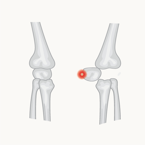 Kneecap Dislocation