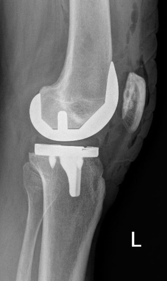 Total Knee Replacement