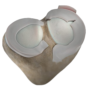 Meniscus Sugery