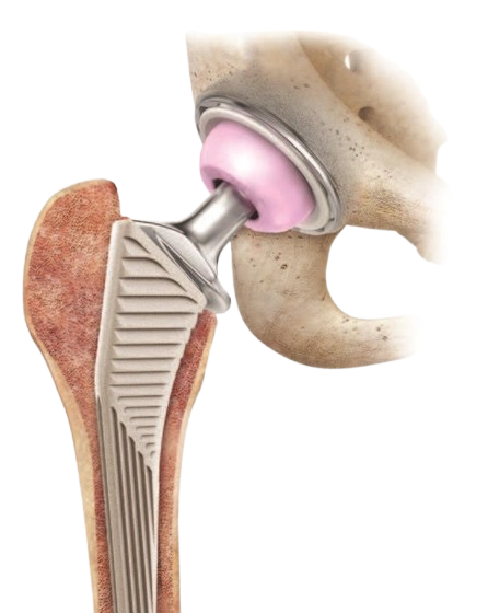 Total Hip Replacement - Hero