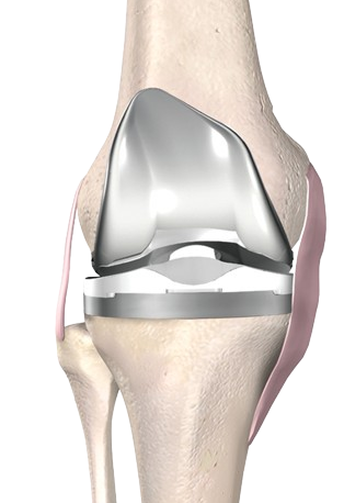 Total Knee Replacement - Hero